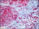Wolman disease in liver