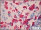 Wolman disease in liver