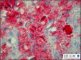 Wolman disease in liver