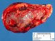 Adrenal hematoma