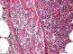 Fungal cutaneous vasculitis in systemic invasive aspergillosis