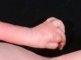 Camptodactyly in a Pena-Shokeir syndrome