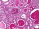 WT-associated diffuse mesangial sclerosis