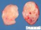 Primitive myxoid mesenchymal tumor of infancy (PMMTI)