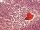 Bone marrow infiltration by large myeloid cells in Kostmann (...)
