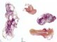 Megacystis, bilateral obstructive multicystic renal dysplasia (BOMRD) with (...)