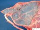 Velamentous insertion of umbilical cord on the amniotic membrane