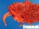 Colectomy of ulcerative colitis