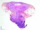 Mycobacterial adenitis with fistulisation to the skin - HE.