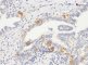pagetoid spread : c-kit IHC