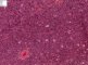 Precursor B lymphoblastic lymphoma