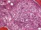 Bone marrow metastasis of a neuroblastoma