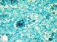 Fetal candida pneumonitis