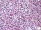 Ewing sarcoma