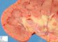 Multiple fungal abcesses in the renal parenchyma