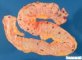Submucosal intestinal hemorrhages in systemic fungal dissemination