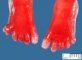 Post-axial polydactyly in Meckel syndrome