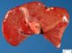 Choledochal atresia and choledochal dilatation in multiple intestinal (...)