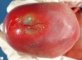Aplasia cutis in alobar holoprosencephaly (Case 13535)