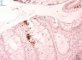 Adenoviral colonic infections