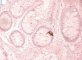 Adenoviral colonic infections