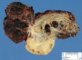 Hemorrhagic necrosis in adnexal torsion (hemorrhagic infarction)