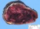 Adrenal neuroblastoma