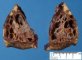 Congenital pulmonary airway malformation type 2 (CPAM type 2 or CCAM type (...)