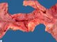 Ileocecal region with Crohn ileitis