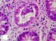 Cryptic abcess in colonic Crohn disease