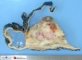 Cystic malignant rhabdoid tumor