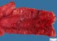 Crohn ileitis (Ileal Crohn disease)
