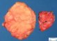 Intermixed ganglioneuroblastoma