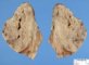 Invasive pulmonary aspergillosis
