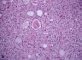 Microscopic medullary thyroid carcinoma with follicular pattern (...)