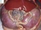 non-syndromal bilateral non-obstructive renal dysplasia