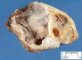 Ovarian serous cystadenoma