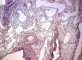 pleuropulmonary blastoma type 1