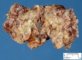 Plexiform neurofibroma in neurofibromatosis type 1 (NF1)