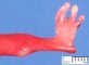 Bilateral radial ray aplasia