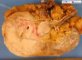 Renal epidermoid carcinoma