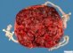 Triple pregnancy placenta
