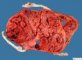 Triple pregnancy placenta