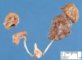 Unilateral renal dysplasia
