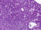 Niemann-Pick disease type B (PAS)