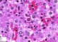 Parvoviral inclusion in fetal liver (hydrops fetalis)