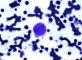 Parvovirus B19 cytopathogenic effect in bone marrow