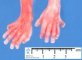 Post-axial polydactyly in Meckel syndrome