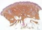 Epidermal nevus with melanocytosis