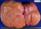 Wolman disease in liver